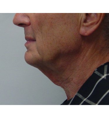 neck lift without scars